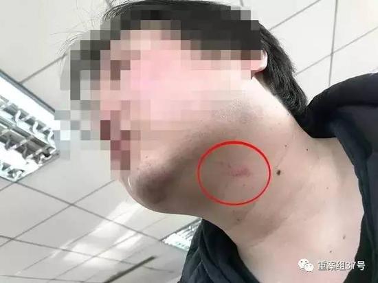 ▲ 被打的新京报记者，脖颈处有明显伤痕。